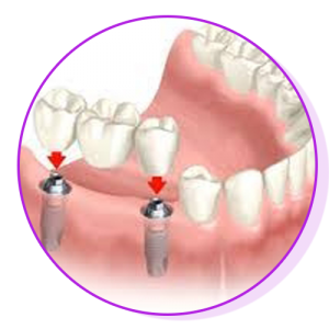 implant1